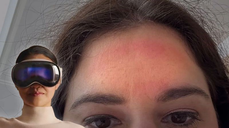 Nếu đeo kính quá lâu có thể để lại hằn đỏ trên mặt của bạn Nếu đeo kính quá lâu có thể để lại hằn đỏ trên mặt của bạn
